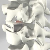 arthrodese cervicale complication arthrodese cervicale avec pose de cage chirurgie du rachis espace francilien du rachis clinique du rachis versailles paris 1