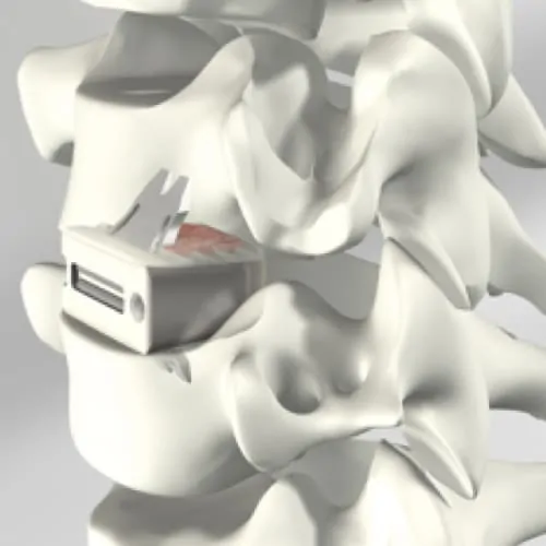 arthrodese cervicale complication arthrodese cervicale avec pose de cage chirurgie du rachis espace francilien du rachis clinique du rachis versailles paris 1 arthrodese cervicale complication arthrodese cervicale avec pose de cage chirurgie du rachis espace francilien du rachis clinique du rachis versailles paris 1