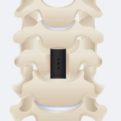 arthrodese cervicale complication arthrodese cervicale avec pose de cage chirurgie du rachis espace francilien du rachis clinique du rachis versailles paris 2