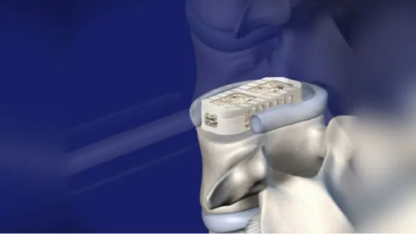 arthrodese lombaire laterale arthrodese lombaire par voie laterale chirurgie du rachis espace francilien du rachis clinique du rachis versailles paris 1 arthrodese lombaire laterale arthrodese lombaire par voie laterale chirurgie du rachis espace francilien du rachis clinique du rachis versailles paris 1