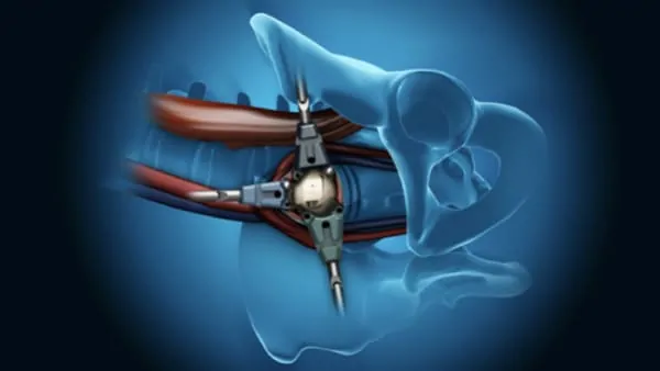 arthrodese lombaire laterale arthrodese lombaire par voie laterale chirurgie du rachis espace francilien du rachis clinique du rachis versailles paris 3