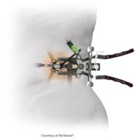 arthrodese lombaire laterale arthrodese lombaire par voie laterale chirurgie du rachis espace francilien du rachis clinique du rachis versailles paris 8