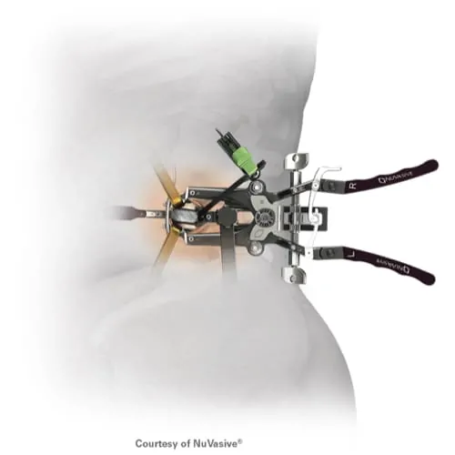 arthrodese lombaire laterale arthrodese lombaire par voie laterale chirurgie du rachis espace francilien du rachis clinique du rachis versailles paris 8