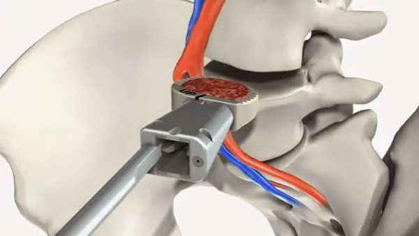 arthrodese lombaire par voie anterieure arthrodese lombaire voie anterieure pourcentage de reussite chirurgie du rachis espace francilien du rachis clinique du rachis versailles paris 2 arthrodese lombaire par voie anterieure arthrodese lombaire voie anterieure pourcentage de reussite chirurgie du rachis espace francilien du rachis clinique du rachis versailles paris 2