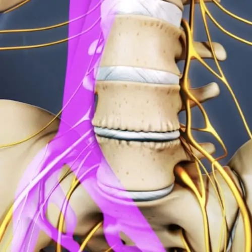 arthrodese lombaire par voie anterieure arthrodese lombaire voie anterieure pourcentage de reussite chirurgie du rachis espace francilien du rachis clinique du rachis versailles paris 4