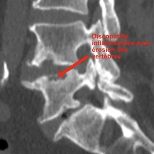 arthrodese lombaire par voie anterieure arthrodese lombaire voie anterieure pourcentage de reussite chirurgie du rachis espace francilien du rachis clinique du rachis versailles paris 6