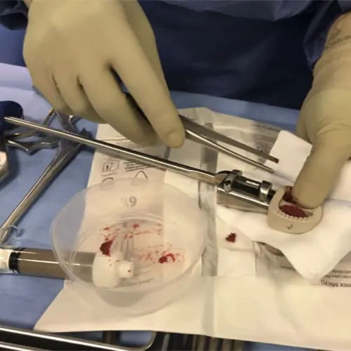 arthrodese lombaire par voie anterieure arthrodese lombaire voie anterieure pourcentage de reussite chirurgie du rachis espace francilien du rachis clinique du rachis versailles paris 7