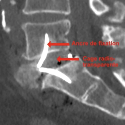 arthrodese lombaire par voie anterieure arthrodese lombaire voie anterieure pourcentage de reussite chirurgie du rachis espace francilien du rachis clinique du rachis versailles paris 8