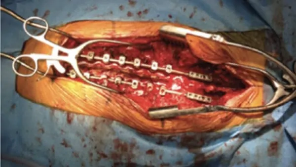 arthrodese lombaire par voie posterieure arthrodese lombaire posterieure chirurgie du rachis espace francilien du rachis clinique du rachis versailles paris 1