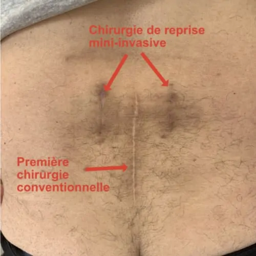 arthrodese lombaire par voie posterieure arthrodese lombaire posterieure chirurgie du rachis espace francilien du rachis clinique du rachis versailles paris 2