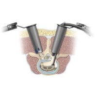 arthrodese lombaire par voie posterieure arthrodese lombaire posterieure chirurgie du rachis espace francilien du rachis clinique du rachis versailles paris 3