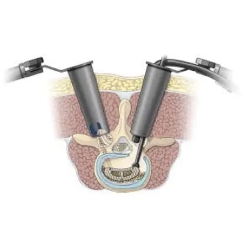 arthrodese lombaire par voie posterieure arthrodese lombaire posterieure chirurgie du rachis espace francilien du rachis clinique du rachis versailles paris 3