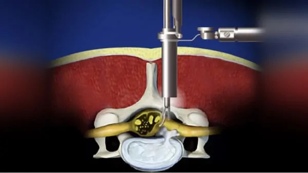 chirurgie d une hernie discale lombaire symptomes hernie discale lombaire operation chirurgie du rachis espace francilien du rachis clinique du rachis versailles paris 1