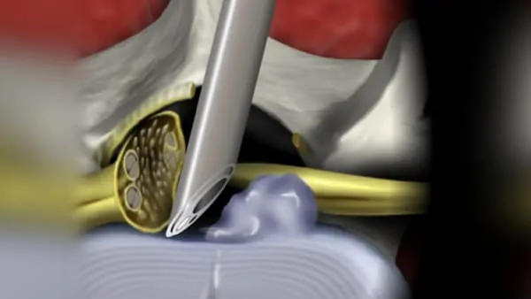 chirurgie d une hernie discale lombaire symptomes hernie discale lombaire operation chirurgie du rachis espace francilien du rachis clinique du rachis versailles paris chirurgie d une hernie discale lombaire symptomes hernie discale lombaire operation chirurgie du rachis espace francilien du rachis clinique du rachis versailles paris