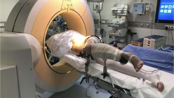 chirurgie du rachis neurostimulation medullaire probleme de dos espace francilien du rachis clinique du rachis versailles paris 2