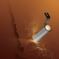chirurgie mini invasive du canal lombaire etroit la chirurgie mini invasive hernie discale espace francilien du rachis clinique du rachis versailles paris 1