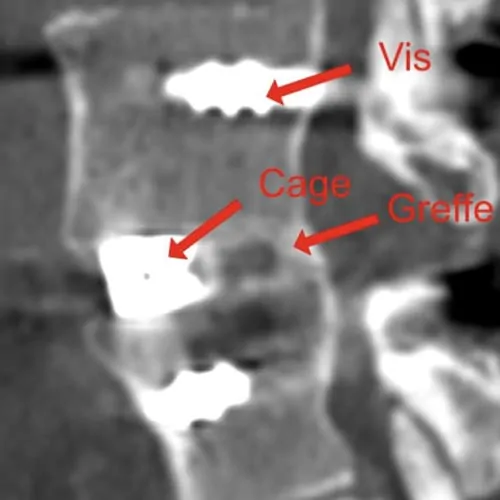 chirurgie mini invasive du canal lombaire etroit la chirurgie mini invasive hernie discale espace francilien du rachis clinique du rachis versailles paris 2