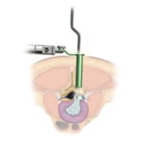 chirurgie mini invasive du canal lombaire etroit la chirurgie mini invasive hernie discale espace francilien du rachis clinique du rachis versailles paris 3