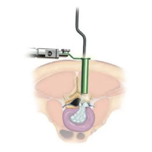 chirurgie mini invasive du canal lombaire etroit la chirurgie mini invasive hernie discale espace francilien du rachis clinique du rachis versailles paris 3