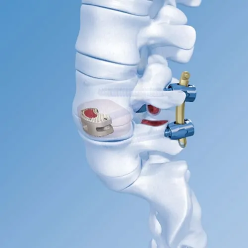 chirurgie mini invasive du canal lombaire etroit la chirurgie mini invasive hernie discale espace francilien du rachis clinique du rachis versailles paris 5
