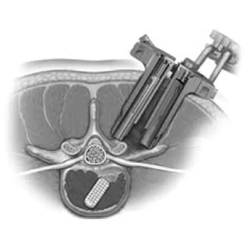 chirurgie mini invasive du canal lombaire etroit la chirurgie mini invasive hernie discale espace francilien du rachis clinique du rachis versailles paris 6