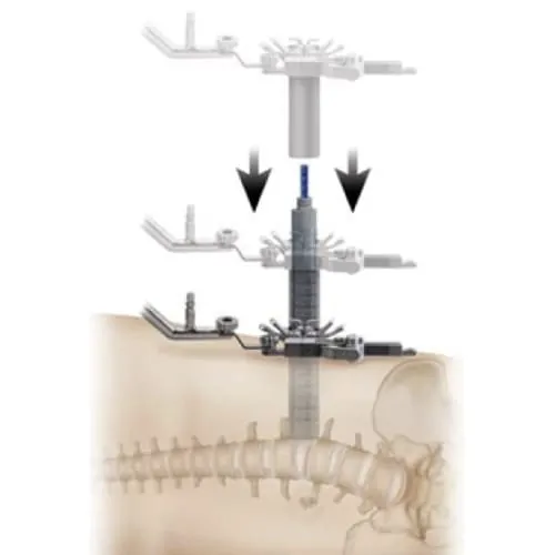 chirurgie mini invasive du canal lombaire etroit la chirurgie mini invasive hernie discale espace francilien du rachis clinique du rachis versailles paris 7