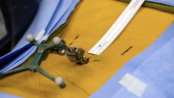 chirurgie mini invasive du canal lombaire etroit la chirurgie mini invasive hernie discale espace francilien du rachis clinique du rachis versailles paris 8