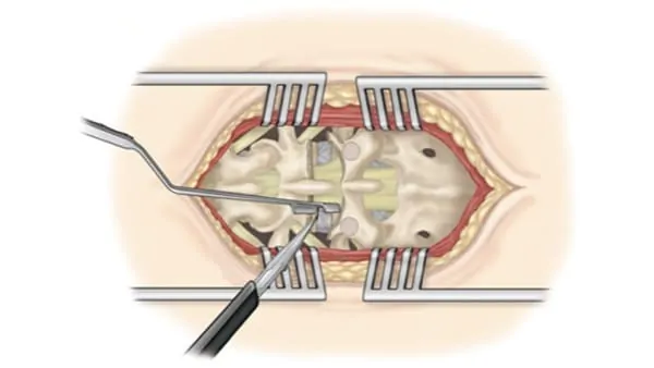 chirurgie mini invasive du canal lombaire etroit la chirurgie mini invasive hernie discale espace francilien du rachis clinique du rachis versailles paris