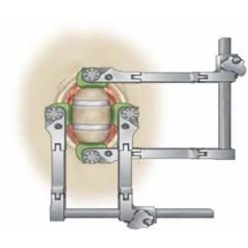 corporectomie cervicale definition corporectomie vertebrale definition corporectomie lombaire chirurgie du rachis espace francilien du rachis clinique du rachis versailles paris 1