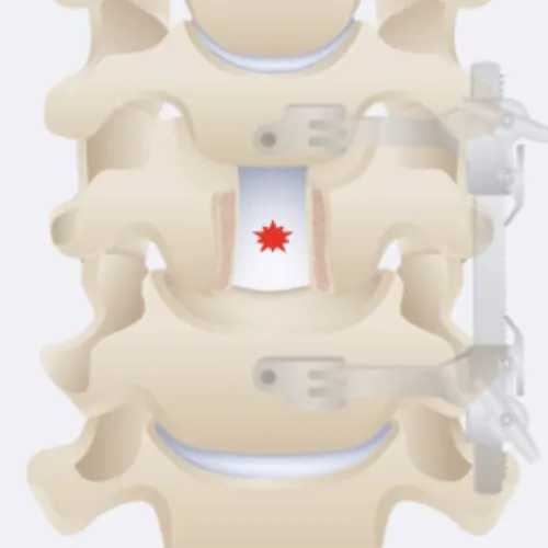 corporectomie cervicale definition corporectomie vertebrale definition corporectomie lombaire chirurgie du rachis espace francilien du rachis clinique du rachis versailles paris 2