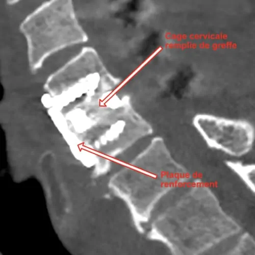 corporectomie cervicale definition corporectomie vertebrale definition corporectomie lombaire chirurgie du rachis espace francilien du rachis clinique du rachis versailles paris 3