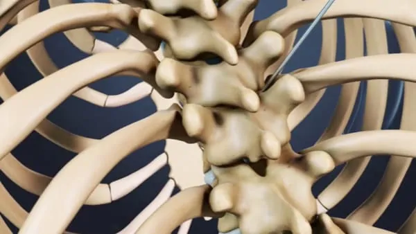 cyphoplastie par ballonnets kyphoplastie vertebroplastie kyphoplastie lombaire chirurgie du rachis espace francilien du rachis clinique du rachis versailles paris 1