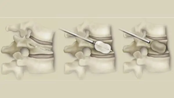 cyphoplastie par ballonnets kyphoplastie vertebroplastie kyphoplastie lombaire chirurgie du rachis espace francilien du rachis clinique du rachis versailles paris 2