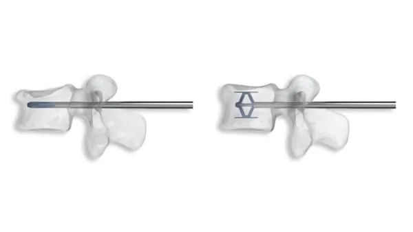 cyphoplastie par ballonnets kyphoplastie vertebroplastie kyphoplastie lombaire chirurgie du rachis espace francilien du rachis clinique du rachis versailles paris 3