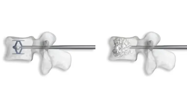 cyphoplastie par ballonnets kyphoplastie vertebroplastie kyphoplastie lombaire chirurgie du rachis espace francilien du rachis clinique du rachis versailles paris 4