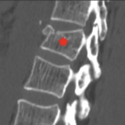 cyphoplastie par ballonnets kyphoplastie vertebroplastie kyphoplastie lombaire chirurgie du rachis espace francilien du rachis clinique du rachis versailles paris 5