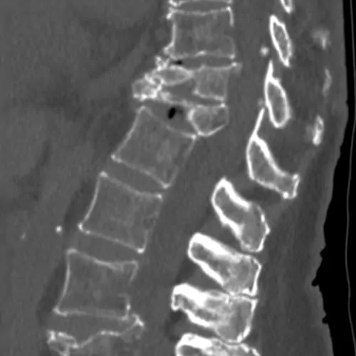 fracture vertebrale osteoporotique fracture colonne vertebrale consequences fracture vertebre temps de guerison espace francilien du rachis clinique du rachis versailles paris 1