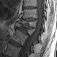 fracture vertebrale osteoporotique fracture colonne vertebrale consequences fracture vertebre temps de guerison espace francilien du rachis clinique du rachis versailles paris 2