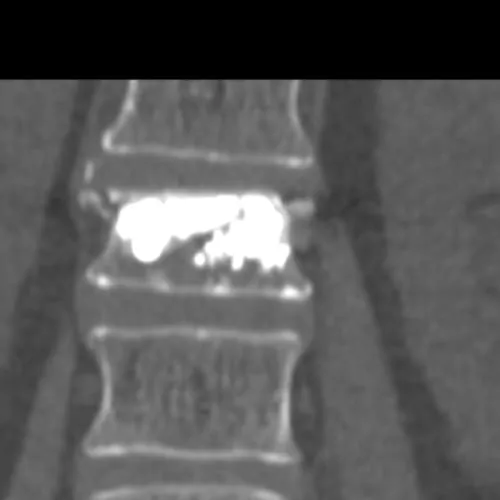 fracture vertebrale osteoporotique fracture colonne vertebrale consequences fracture vertebre temps de guerison espace francilien du rachis clinique du rachis versailles paris