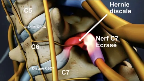 hernie discale symptome nevralgie cervico brachiale hernie discale operation hernie discale cervicale espace francilien du rachis clinique du rachis versailles paris 4