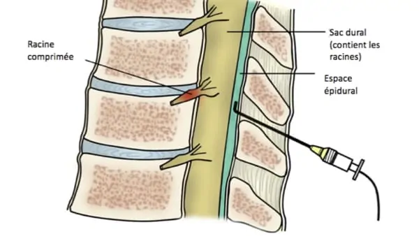 infiltration dos lombaire infiltration du dos infiltration rachis lombaire chirurgie du rachis espace francilien du rachis clinique du rachis versailles paris 1