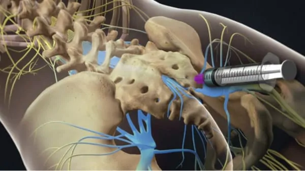 infiltration dos lombaire infiltration du dos infiltration rachis lombaire chirurgie du rachis espace francilien du rachis clinique du rachis versailles paris 2