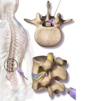infiltration rachis cervical infiltration du rachis lombaire infiltration dos avis chirurgie du rachis espace francilien du rachis clinique du rachis versailles paris 1