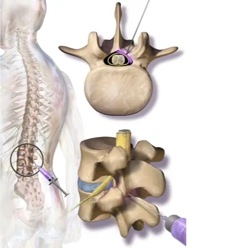infiltration rachis cervical infiltration du rachis lombaire infiltration dos avis chirurgie du rachis espace francilien du rachis clinique du rachis versailles paris 1