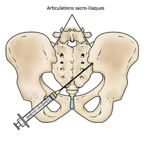 infiltration rachis cervical infiltration du rachis lombaire infiltration dos avis chirurgie du rachis espace francilien du rachis clinique du rachis versailles paris 2