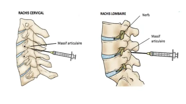 infiltration rachis cervical infiltration du rachis lombaire infiltration dos avis chirurgie du rachis espace francilien du rachis clinique du rachis versailles paris