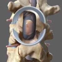 laminectomie lombaire laminectomie definition laminectomie cervicale reeducation chirurgie du rachis espace francilien du rachis clinique du rachis versailles paris 5