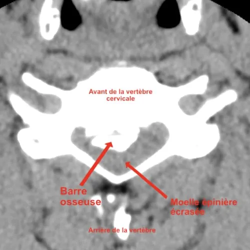 myelopathie cervico arthrosique myelopathie cervicarthrosique et fatigue myelopathie cervicarthrosique irm espace francilien du rachis clinique du rachis versailles paris 1