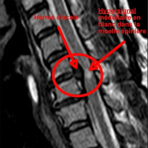 myelopathie cervico arthrosique myelopathie cervicarthrosique et fatigue myelopathie cervicarthrosique irm espace francilien du rachis clinique du rachis versailles paris
