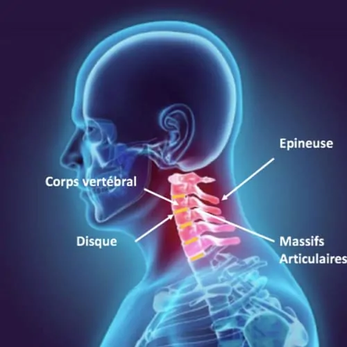 nevralgie cervico brachiale traitement nevralgie cervico brachial nevralgie cervico brachiale cause espace francilien du rachis clinique du rachis versailles paris 3